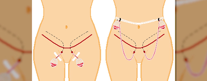 Tummy tuck drains.