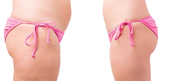 Liposuction results.