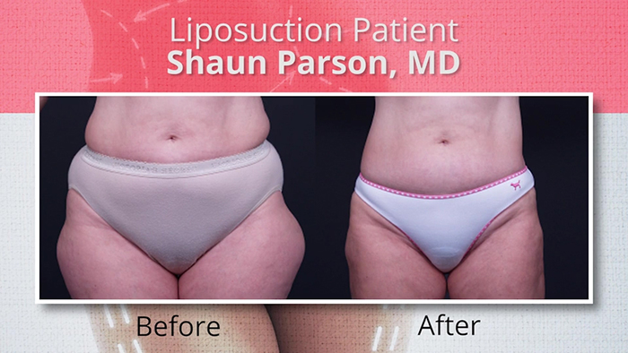 Female liposuction patient.