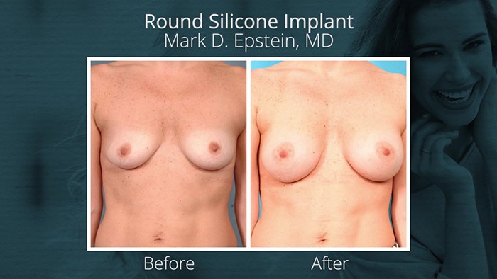 Round silicone breast implant before and after.