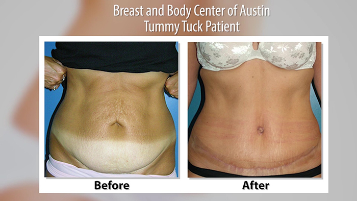 Drainless tummy tuck before and after.