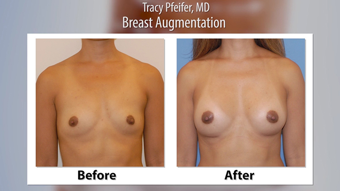 Breast augmentation before and after.