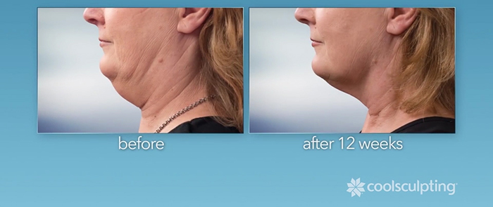 CoolSculpting before and after - neck.