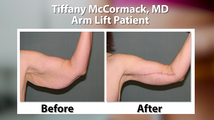 Arm lift before and after - Dr. McCormack.