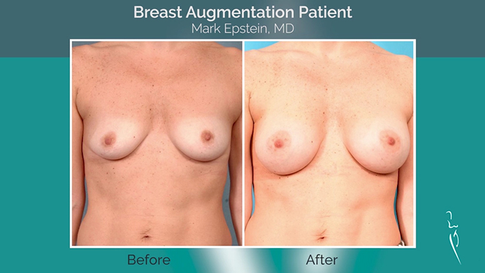 Breast augmentation with Inspira SoftTouch.