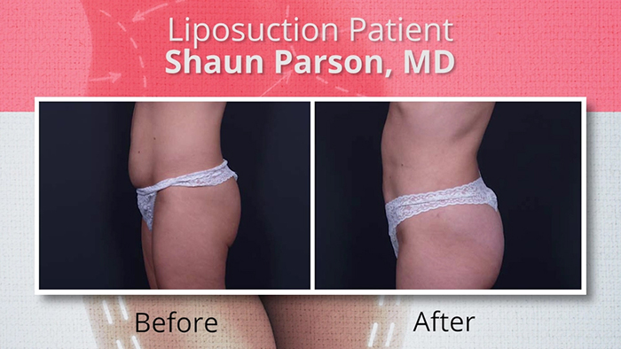 Female liposuction patient 2.