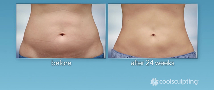 CoolSculpting before and after - abdomen.