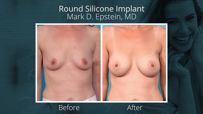 Round silicone breast implant results.