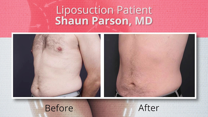 Male liposuction patient.