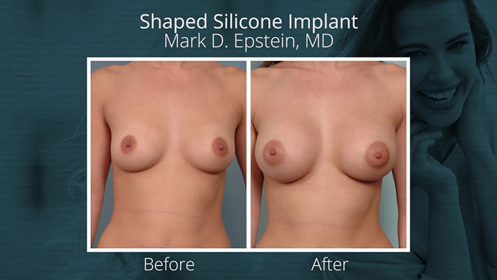 Shaped silicone breast implant results.