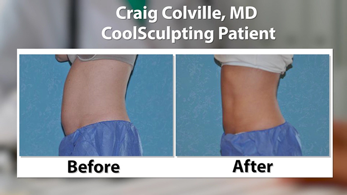 CoolSculpting results from a plastic surgeon.