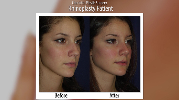Nose fixing with rhinoplasty - before and after.