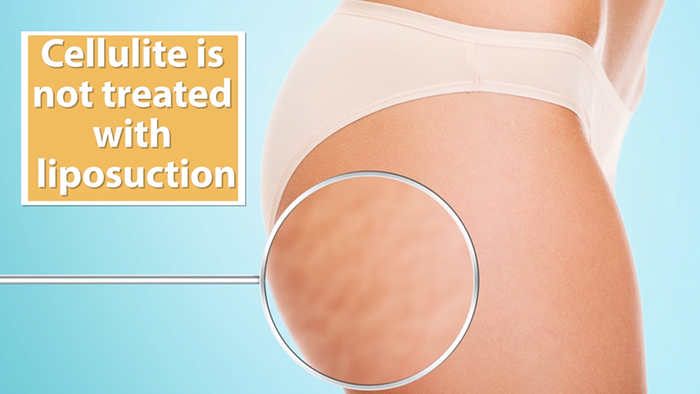 Liposuction does not address cellulite.