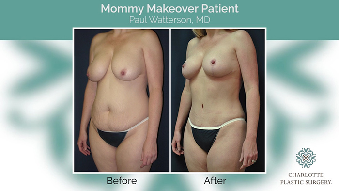 Mommy makeover patient - Dr. Watterson.
