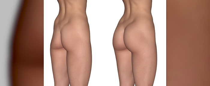 Contour reshaping with buttock augmentation.