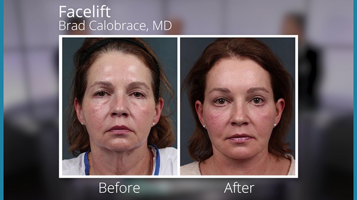 Facelift patient - Dr. Calobrace.