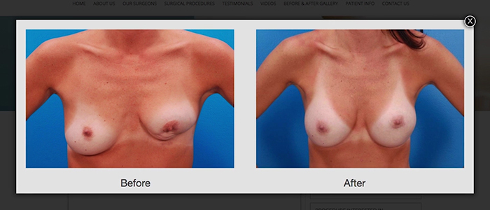 Breast revision results.