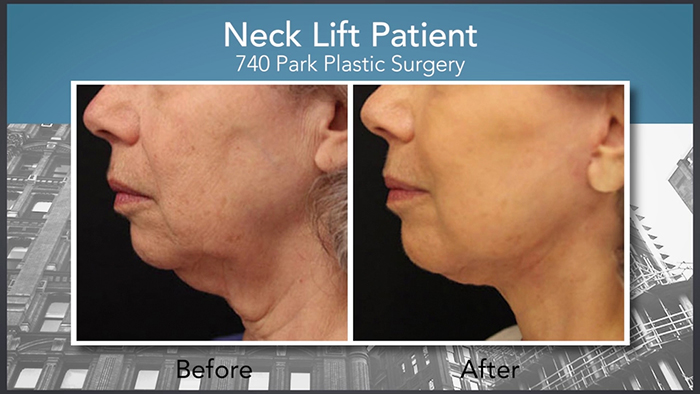 Neck lift - Dr. Broumand.