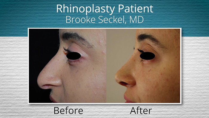 Rhinoplasty before and after.