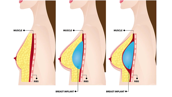 Implant placement - over vs. under.