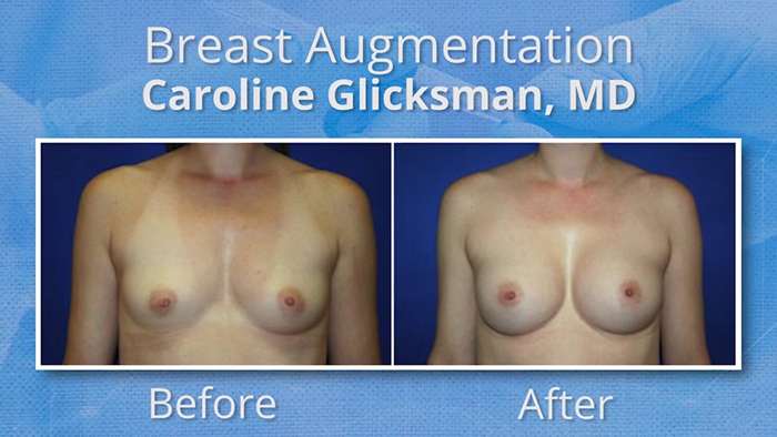 Experience matters in breast augmentation.