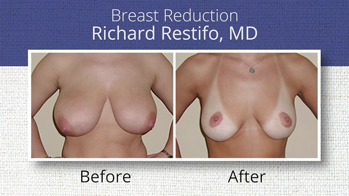 Dr. Restifo breast reduction before and afters.