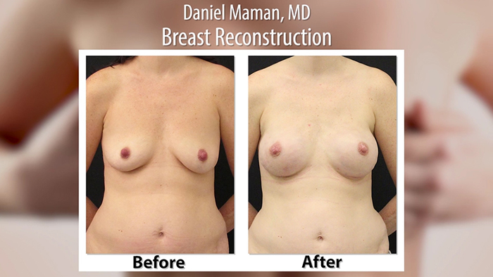 Breast revision before and after.