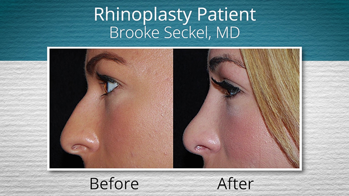 Rhinoplasty patient - Dr. Seckel.