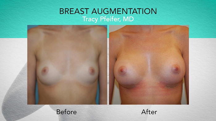 Implant placement before and after - Dr. Pfeifer.