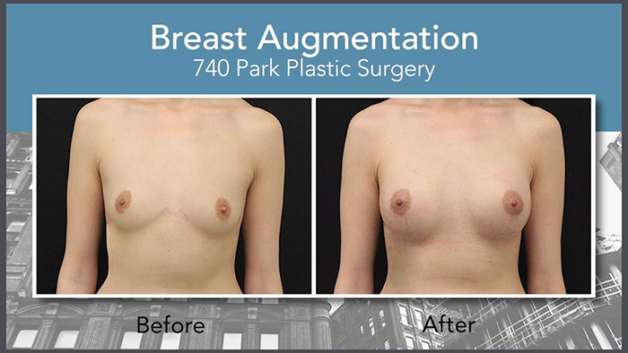 Breast augmentation results - Dr. Maman.