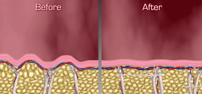 The Cellfina treatment process.