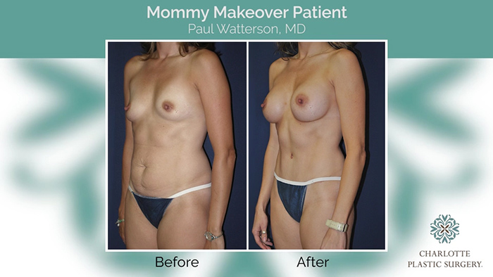 A mommy makeover patient - Dr. Paul Watterson.