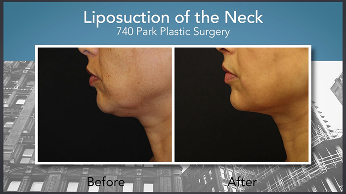 Neck lift with liposuction.