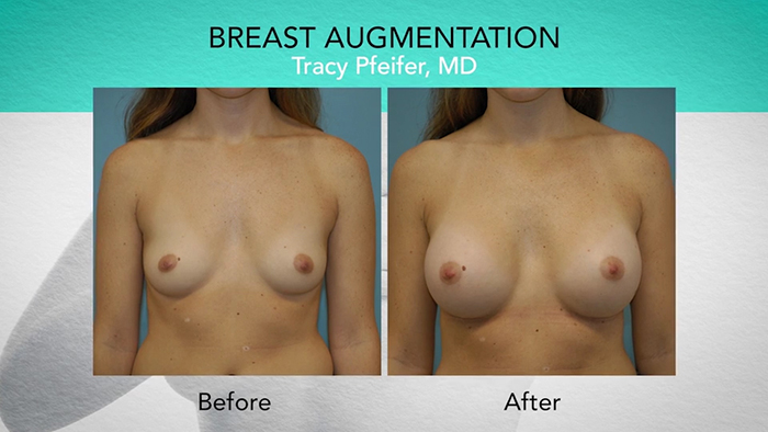 Implant placement - Dr. Pfeifer.