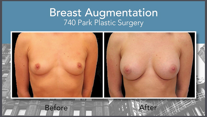Natural looking breast augmentation result.