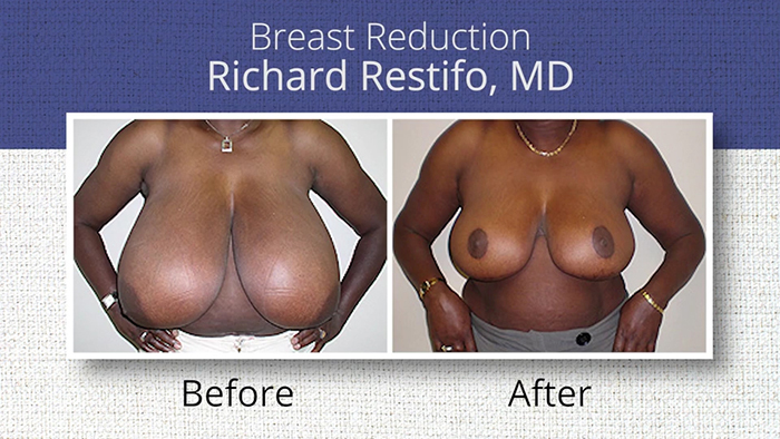 Breast reduction before and after.
