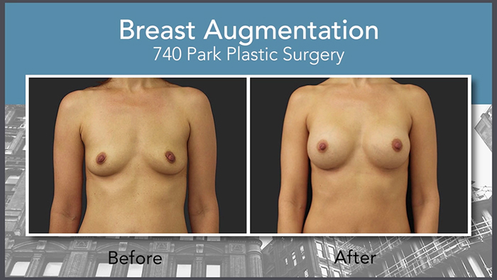 Natural looking breast augmentation.
