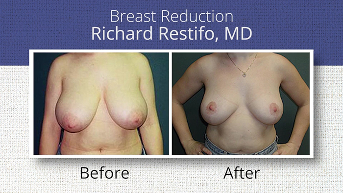Breast reduction results - Dr. Restifo.
