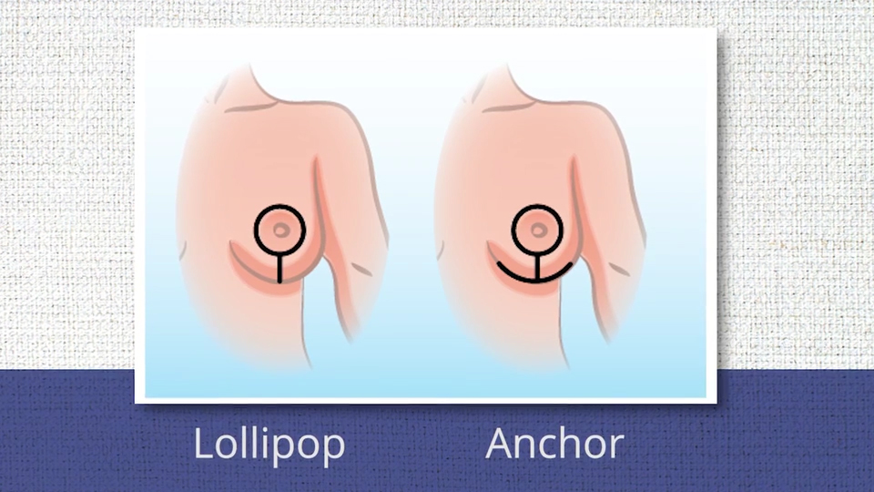 Breast reduction incisions.