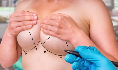 Breast Revision - It's More Complicated the Second Time Around.