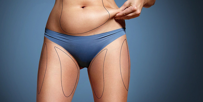 Liposculpture - sculpting the body with liposuction.