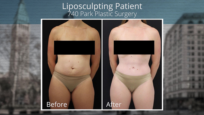 Female liposculpture patient.