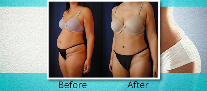 Lipoabdominoplasty before and after.