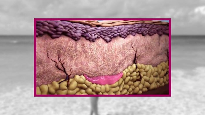 Sculptra Buttock Lift.