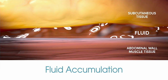 Avoiding fluid accumulation with a drainless tummy tuck.