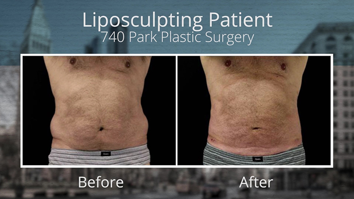 Liposculpture patient.