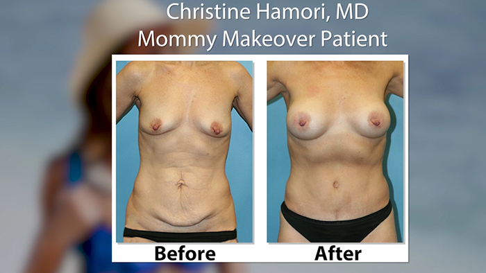 Mommy makeover patient - Dr. Hamori.