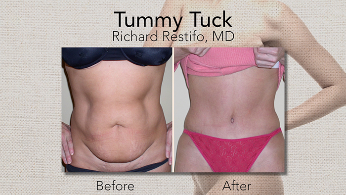 Drainless tummy tuck results.