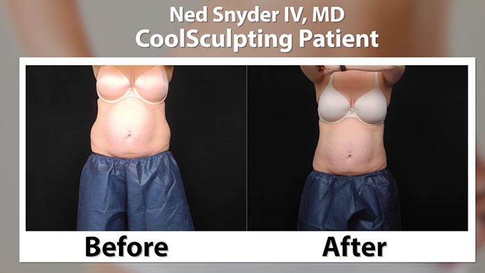 CoolSculpting results.