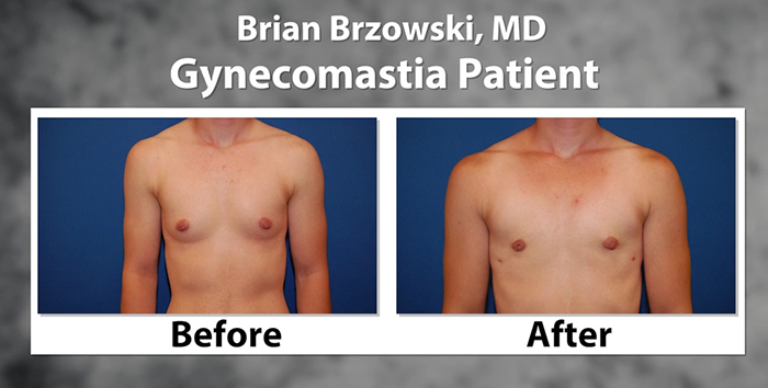 Preserving masculinity by treating gynecomastia.